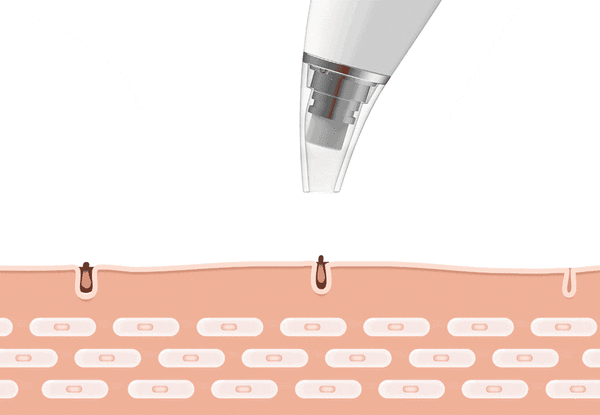 Blackhead Borttagare Vacuum Pore Rengöringsverktyg