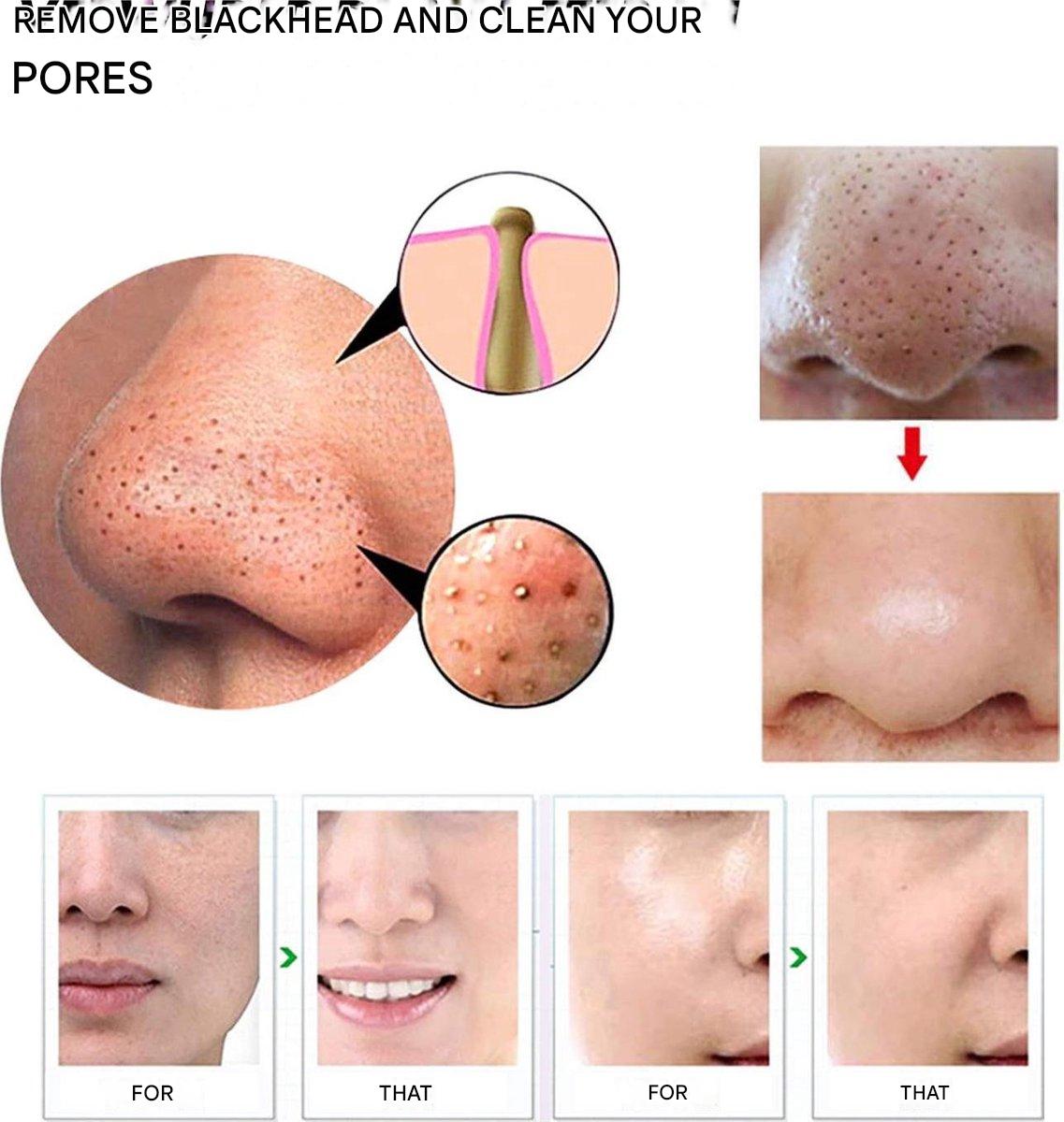 Carvallo PureGlow | Med 5 munstycken | Trådlös & smärtfri | Mot pormaskar & orenheter