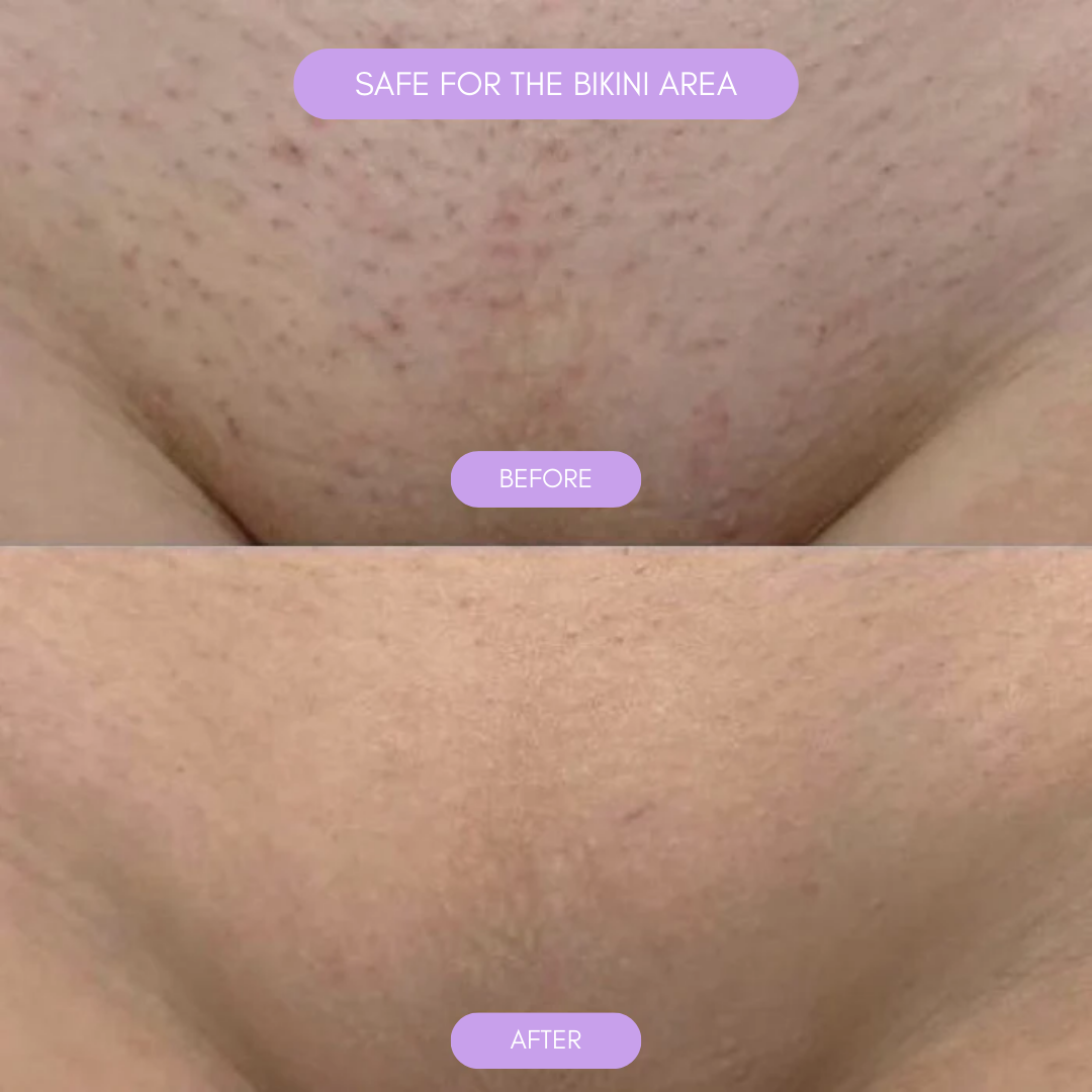 Hårborttagningsapparat för mjuk len hud