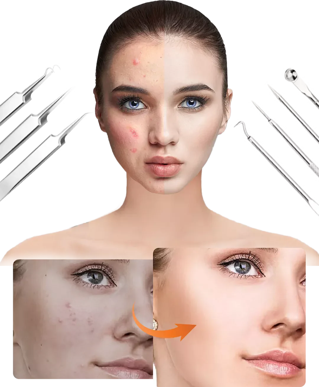 Carvallo Set PureSkinX | Precise & Hygienic | Stainless Steel Tools for Clear Skin