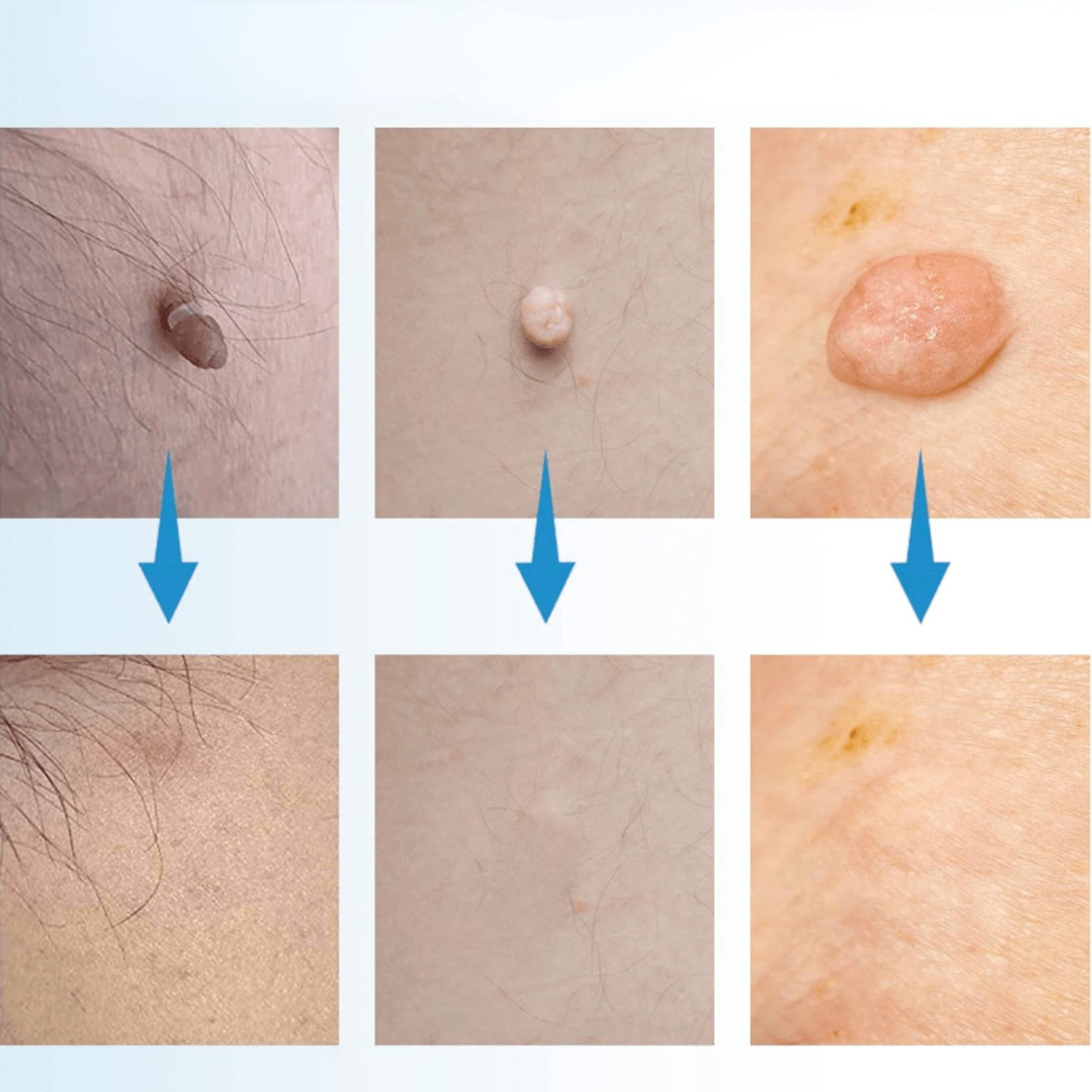 Carvallo – Naturlig vårtorpsavlägsnare