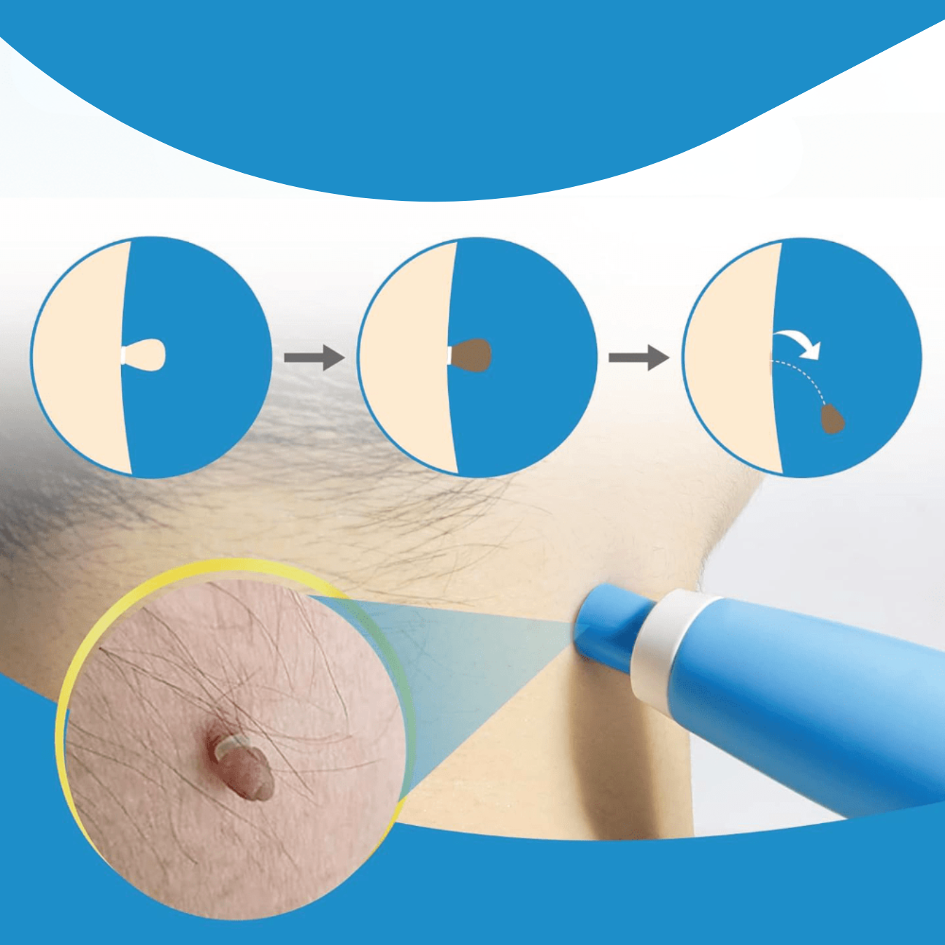 Carvallo – Naturlig vårtorpsavlägsnare
