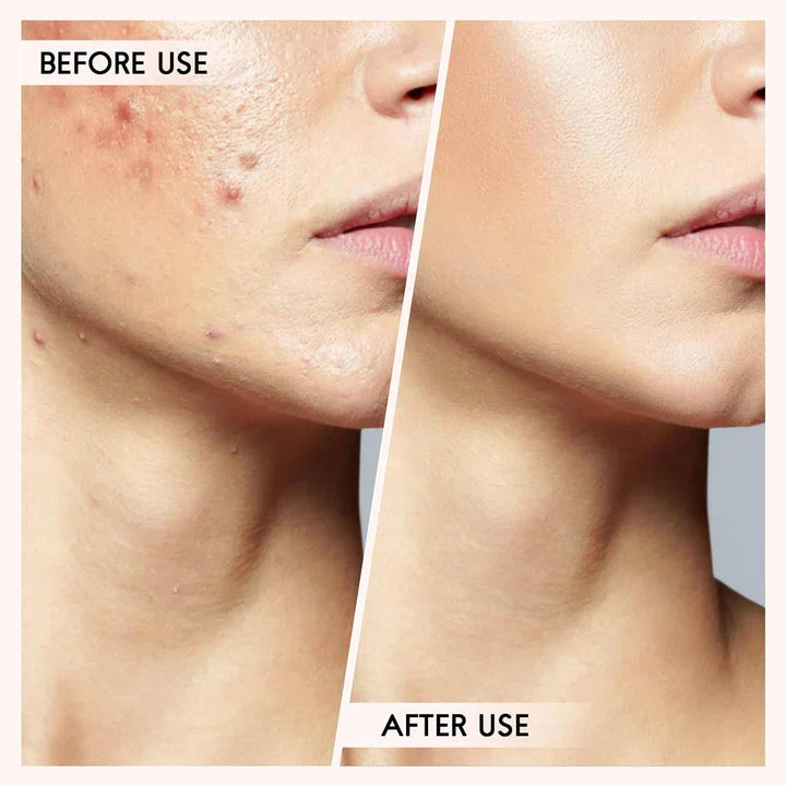 Pormask- och finnarborttagningsset