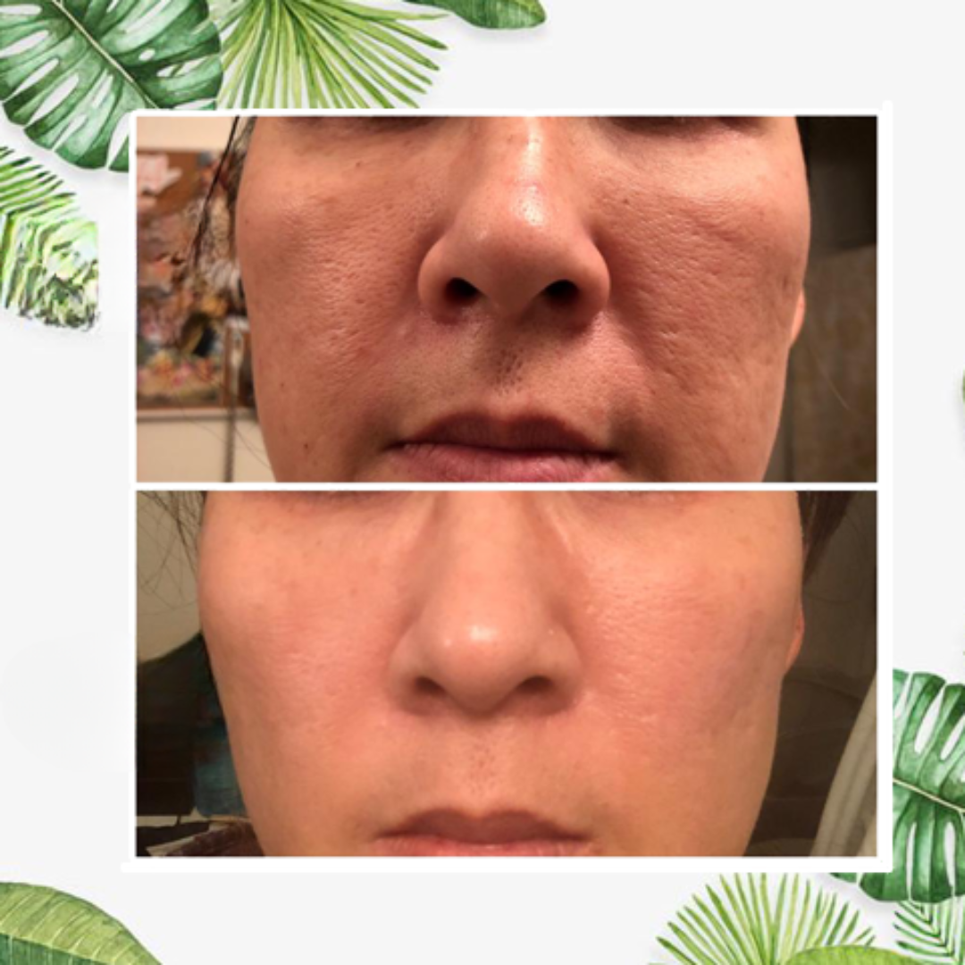 Ansiktsmaskpinne för fet hud detox