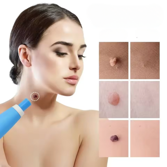 Carvallo – Naturlig vårtorpsavlägsnare