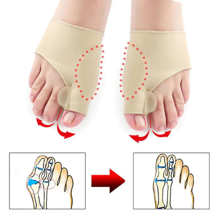 Hallux-Valgus-korrigeringsskydd (1 par)