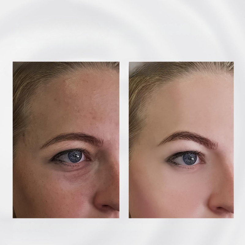 Facial Roller Rostfritt Stål Svullnad Massager