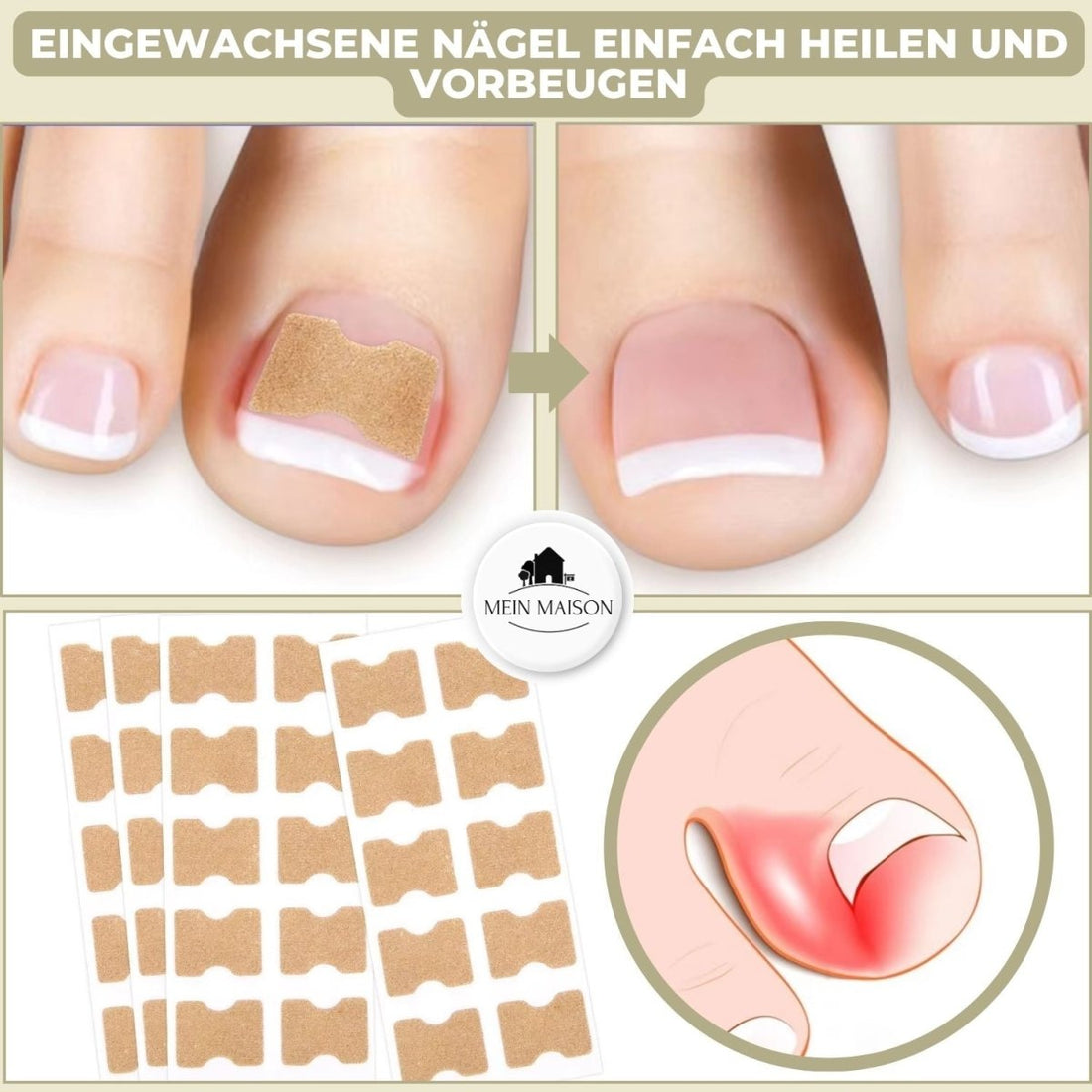ALIGNSTRIP – Smärtfri nagelkorrektionsremsa för ingrodda och deformerade naglar