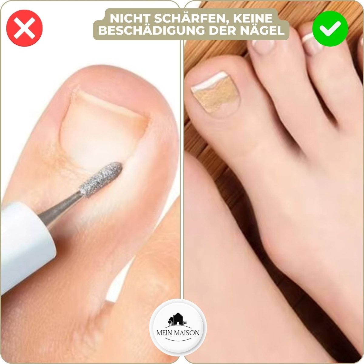 ALIGNSTRIP – Smärtfri nagelkorrektionsremsa för ingrodda och deformerade naglar