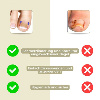 ALIGNSTRIP – Smärtfri nagelkorrektionsremsa för ingrodda och deformerade naglar