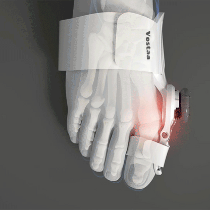 Carvallo - Hallux valgus-korrigerare